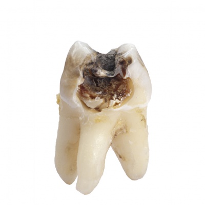 decayed tooth