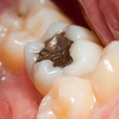 dental filling
