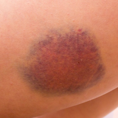 bruise